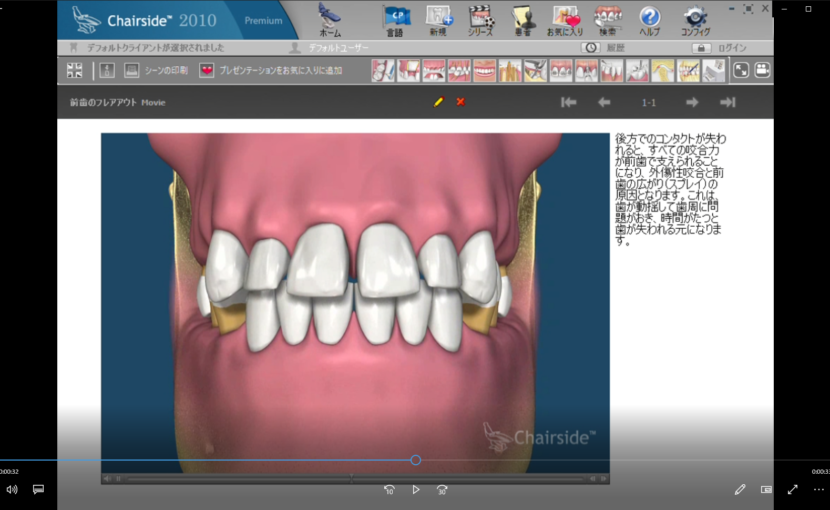 ７欠損歯とインプラント概念　B力の分配と咬合ー前歯のフレアアウト