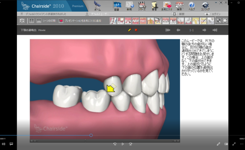 ７欠損歯とインプラント概念　A欠損歯と歯の移動ー下顎の過萌出