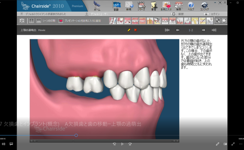 ７欠損歯とインプラント概念　A欠損歯と歯の移動ー上顎の過萌出