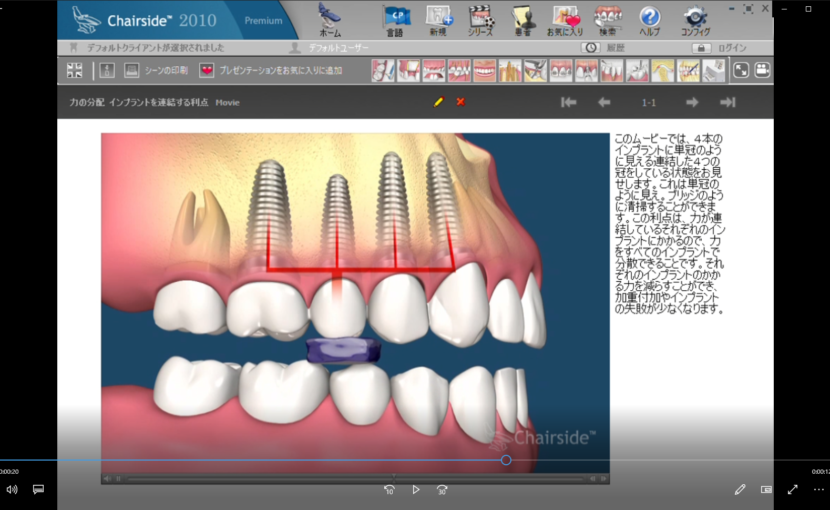 ７欠損歯とインプラント(概念)　B力の分配と咬合ー力の分配　インプラントを連結する利点
