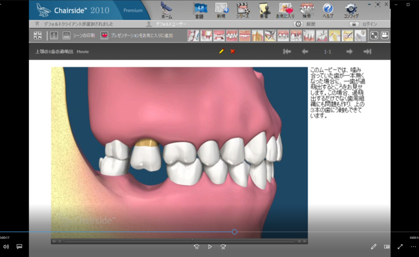 ７欠損歯とインプラント(概念)　A欠損歯と歯の移動ー上顎の1歯の過萌出
