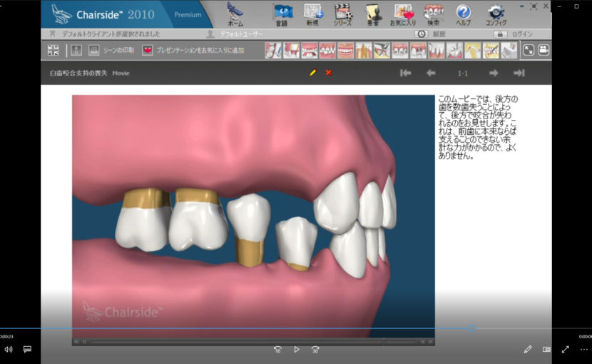 ７欠損歯とインプラント概念　B力の分配と咬合ー臼歯咬合支持の喪失