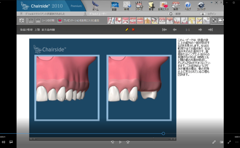 ３骨吸収と移植　C上顎の骨増大術ー抜歯と吸収　上顎　前方歯肉観