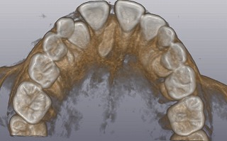 歯列矯正に最適な年齢について